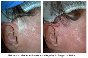 Scar camouflage for facelift scars