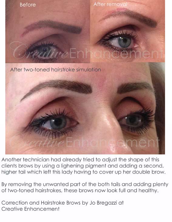 Removal of permanent brows and shape correction