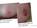 Nipple_before-and-after_2.jpg