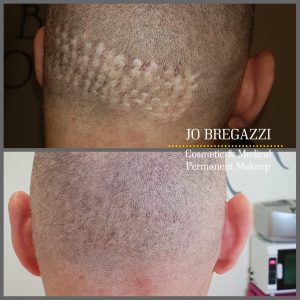 Medical tattooing for hair replacement scars