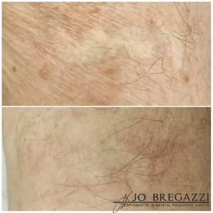 Scar camouflage with Skin toned medical tattooing by Jo Bregazzi