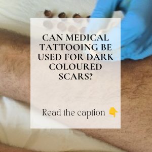 Can medical tattooing be used to cover dark coloured scars?